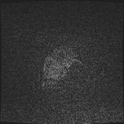 Cavernous sinus meningioma (Radiopaedia 63682-72367 Sagittal T1 C+ 7).jpg