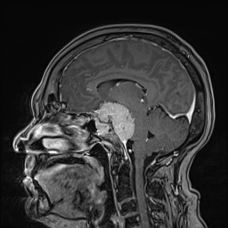 Cavernous sinus meningioma (Radiopaedia 63682-72367 Sagittal T1 C+ 87).jpg