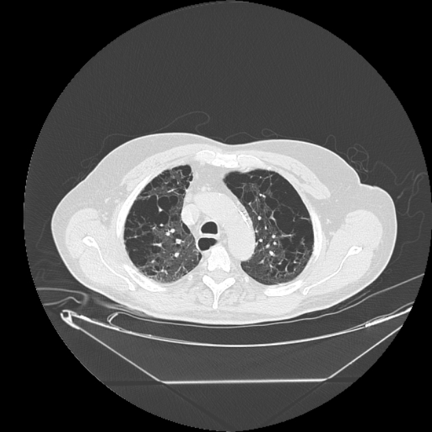 Cavitating bronchogenic carcinoma (Radiopaedia 44489-48162 Axial lung window 19).jpg