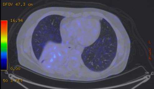 File:Cavitating lung mass - squamous cell carcinoma (Radiopaedia 48047-52853 A 62).png
