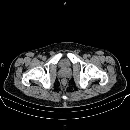 Cecal adenocarcinoma (Radiopaedia 85324-100916 Axial non-contrast 99).jpg