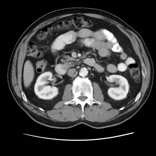 Cecal mass causing appendicitis (Radiopaedia 59207-66531 A 37).jpg