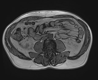 Cecal mass causing appendicitis (Radiopaedia 59207-66532 D 78).jpg