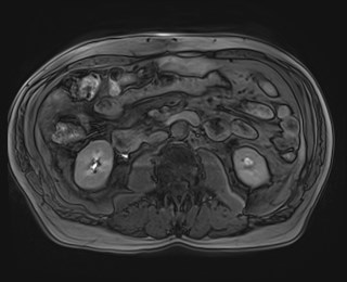 Cecal mass causing appendicitis (Radiopaedia 59207-66532 K 68).jpg