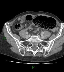 Cecal volvulus (Radiopaedia 86741-102900 A 94).jpg