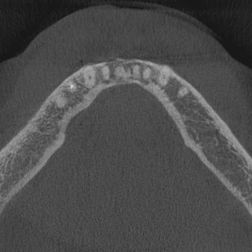 File:Cemento-osseous dysplasia (Radiopaedia 48251-53126 Axial non-contrast 23).jpg