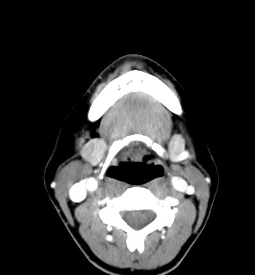 File:Cemento-ossifying fibroma (Radiopaedia 46243-50643 Axial C+ delayed 46).png