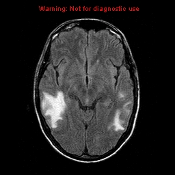 File:Central nervous system vasculitis (Radiopaedia 8410-9235 Axial FLAIR 11).jpg