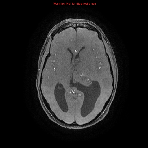 Central neurocytoma (Radiopaedia 13188-13206 Axial MRA 51).jpg
