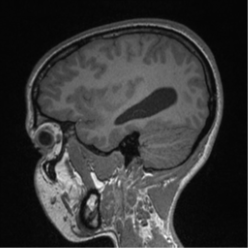 Central neurocytoma (Radiopaedia 37664-39557 Sagittal T1 27).png