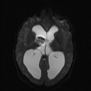 Central neurocytoma (Radiopaedia 56690-63469 Axial DWI 9).jpg