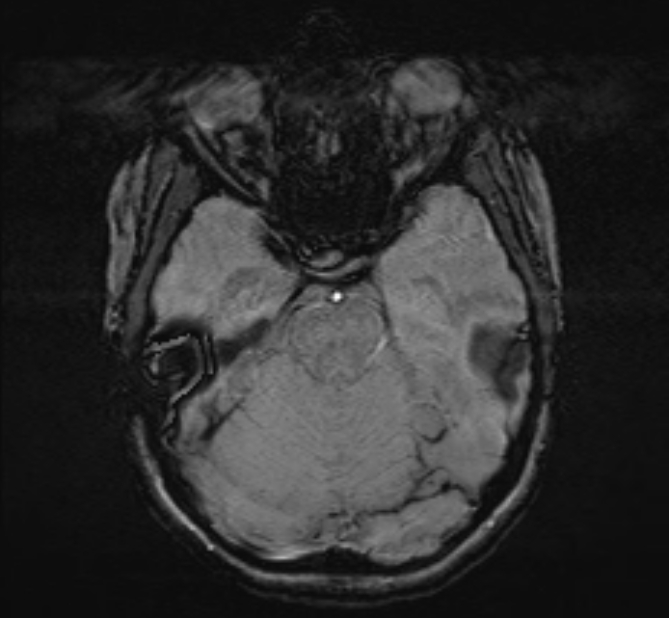 Central neurocytoma (Radiopaedia 70263-80336 Axial SWI 17).jpg