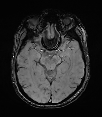 File:Central neurocytoma (Radiopaedia 71068-81303 Axial SWI 24).jpg