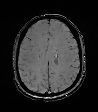 File:Central neurocytoma (Radiopaedia 71068-81303 Axial SWI 44).jpg