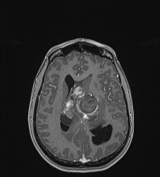 File:Central neurocytoma (Radiopaedia 84497-99872 Axial T1 C+ 94).jpg