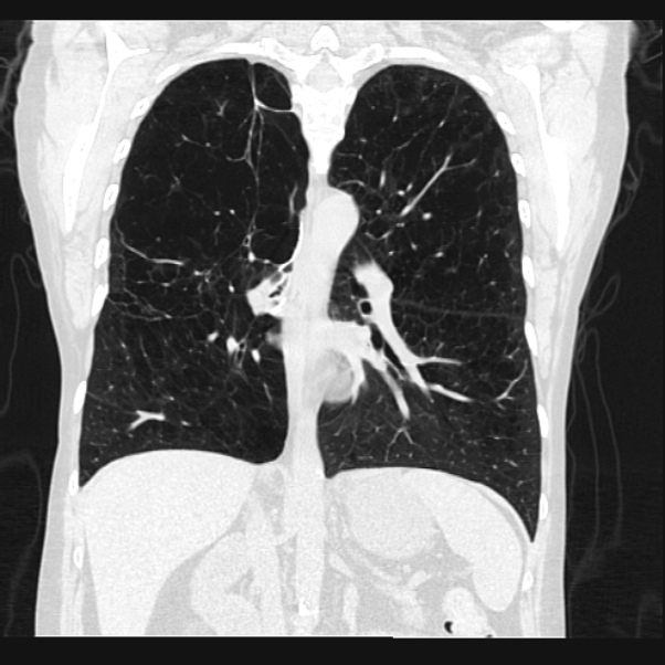 Centrilobular pulmonary emphysema (Radiopaedia 24495-24789 Coronal lung window 44).jpg