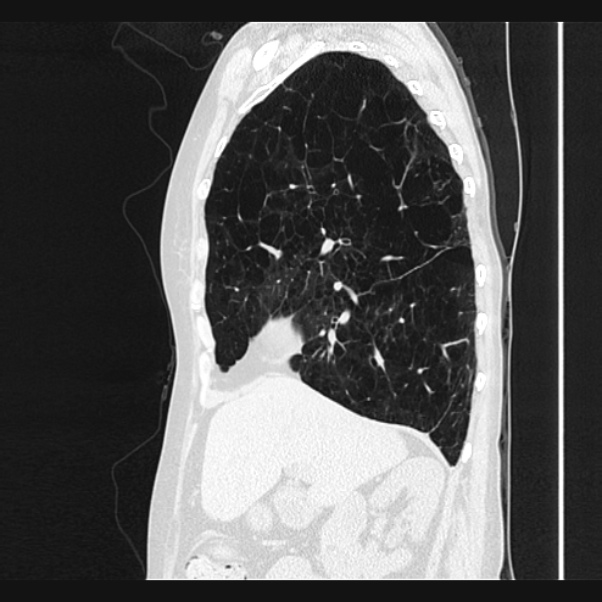 Centrilobular pulmonary emphysema (Radiopaedia 24495-24789 Sagittal lung window 28).jpg