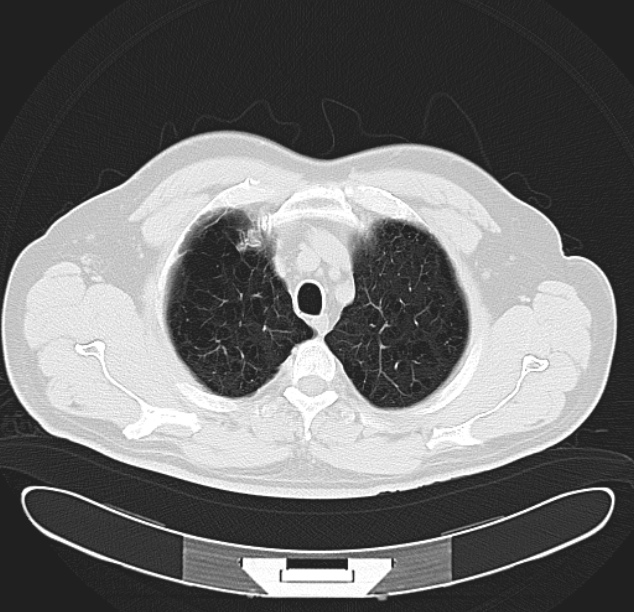 Centrilobular pulmonary emphysema (Radiopaedia 26808-26971 C 7).jpg