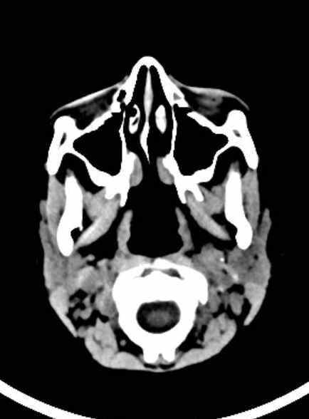 Cerebellar abscess (Radiopaedia 73727-84527 Axial non-contrast 15).jpg