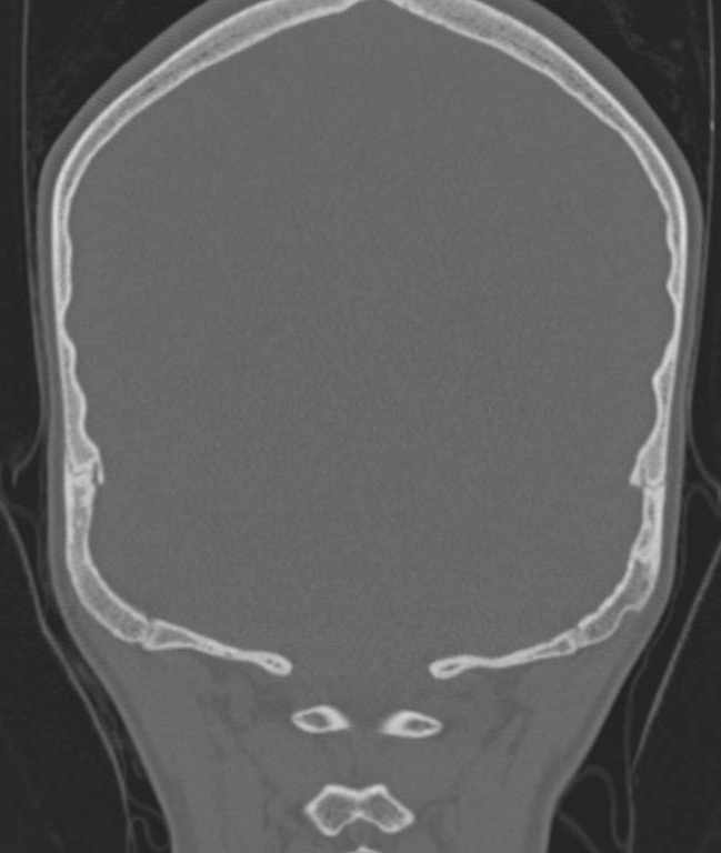 Cerebellar abscess (Radiopaedia 73727-84527 Coronal bone window 14).jpg