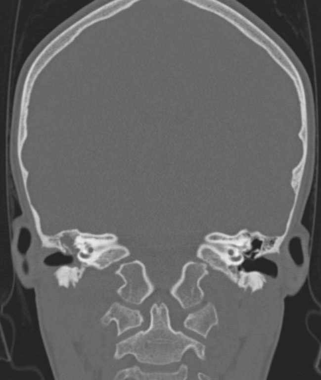 Cerebellar abscess (Radiopaedia 73727-84527 Coronal bone window 61).jpg