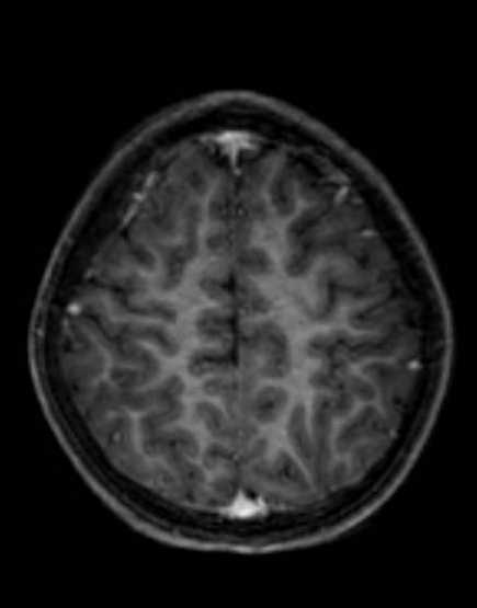 Cerebellar abscess (Radiopaedia 73727-84563 Axial T1 C+ fat sat 88).jpg