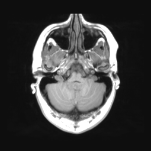File:Cerebellar ependymoma complicated by post-operative subdural hematoma (Radiopaedia 83322-97736 Axial T1 10).png