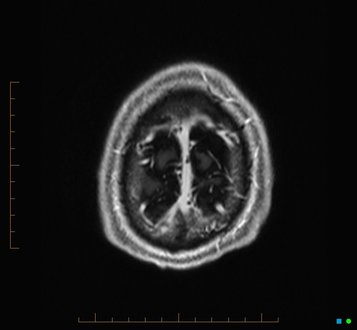 Cerebellar gangliocytoma (Radiopaedia 65377-74422 Axial T1 C+ 136).jpg