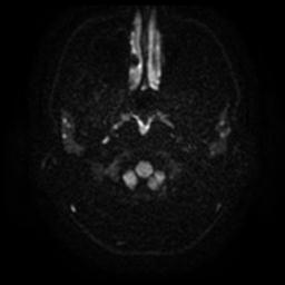 Cerebellar hemangioblastoma (Radiopaedia 29570-30077 Axial DWI 3).jpg