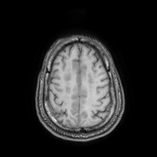 File:Cerebellar hemangioblastoma (Radiopaedia 88055-104622 Axial T1 28).jpg