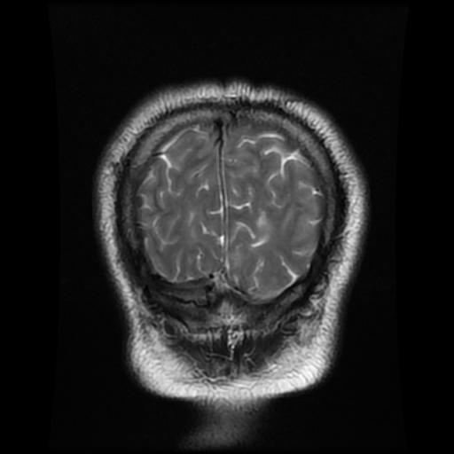 File:Cerebellar hemangioblastoma (Radiopaedia 88055-104622 Coronal T2 17).jpg