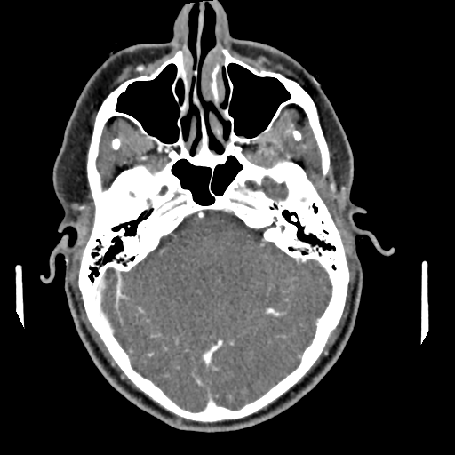Cerebellar infarct due to vertebral artery dissection with posterior fossa decompression (Radiopaedia 82779-97029 C 13).png
