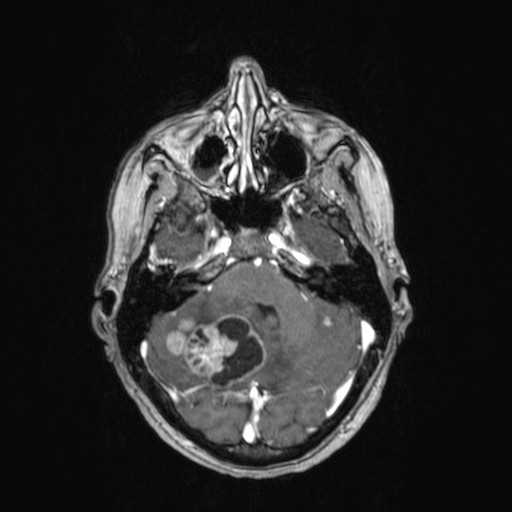 Cerebellar metastases (Radiopaedia 24038-24249 Axial T1 C+ 38).jpg