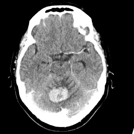 File:Cerebellar metastasis (Radiopaedia 54578-60812 Axial C+ 18).png