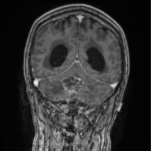 File:Cerebellar metastasis from lung adenocarcinoma (Radiopaedia 86690-102829 Coronal T1 C+ 32).png