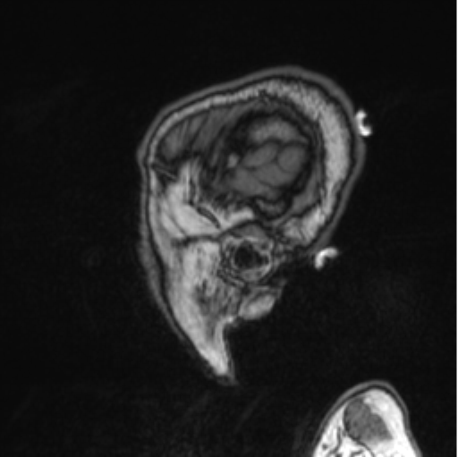 Cerebellar metastasis from lung adenocarcinoma (Radiopaedia 86690-102829 Sagittal T1 85).png