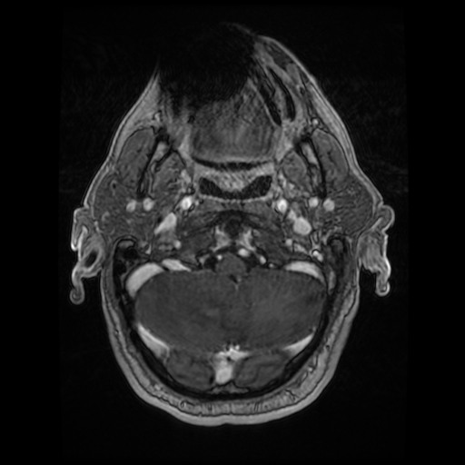 Cerebellar metastasis of pulmonary adenocarcinoma, cavernous venous malformation, and developmental venous anomaly (Radiopaedia 85827-101661 Axial T1 C+ 20).jpg