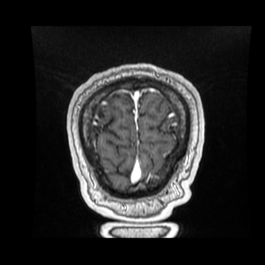 Cerebellar metastasis of pulmonary adenocarcinoma, cavernous venous malformation, and developmental venous anomaly (Radiopaedia 85827-101661 Coronal T1 C+ 17).jpg