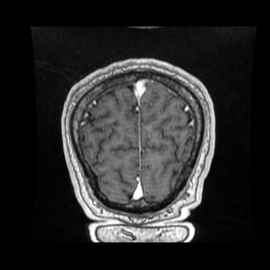 Cerebellar metastasis of pulmonary adenocarcinoma, cavernous venous malformation, and developmental venous anomaly (Radiopaedia 85827-101661 Coronal T1 C+ 21).jpg