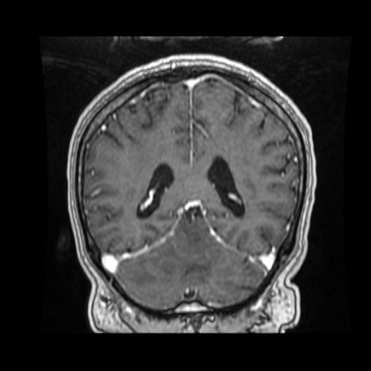 Cerebellar metastasis of pulmonary adenocarcinoma, cavernous venous malformation, and developmental venous anomaly (Radiopaedia 85827-101661 Coronal T1 C+ 37).jpg