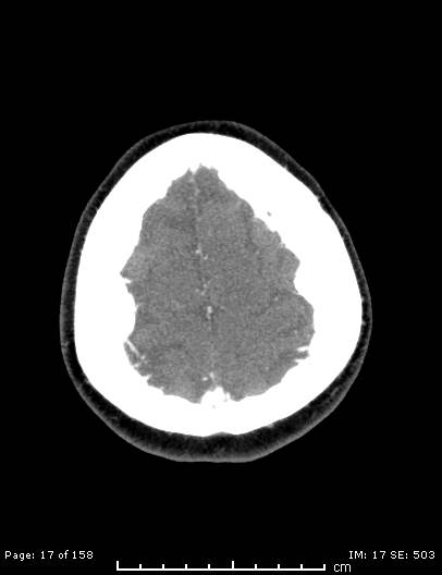 Cerebellar strokes due to intracranial giant cell arteritis (Radiopaedia 68799-78510 CT angiogram 17).jpg