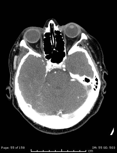 Cerebellar strokes due to intracranial giant cell arteritis (Radiopaedia 68799-78510 CT angiogram 55).jpg