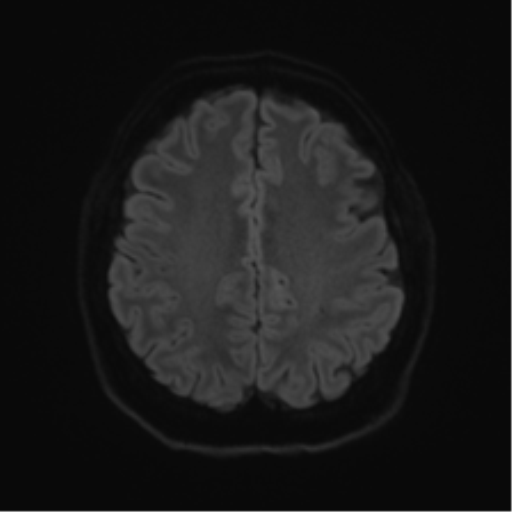 Cerebellopontine angle meningioma (Radiopaedia 48434-53348 Axial DWI 64).png