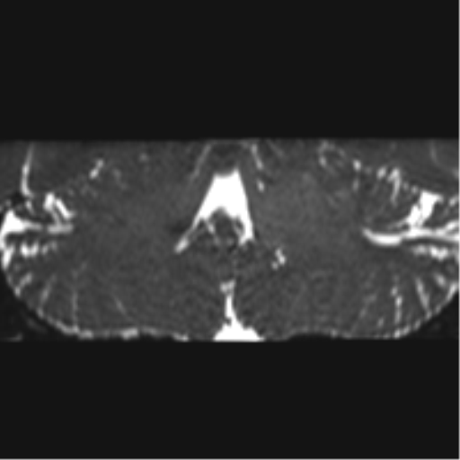 Cerebellopontine angle meningioma (Radiopaedia 48434-53348 Coronal T2 27).png