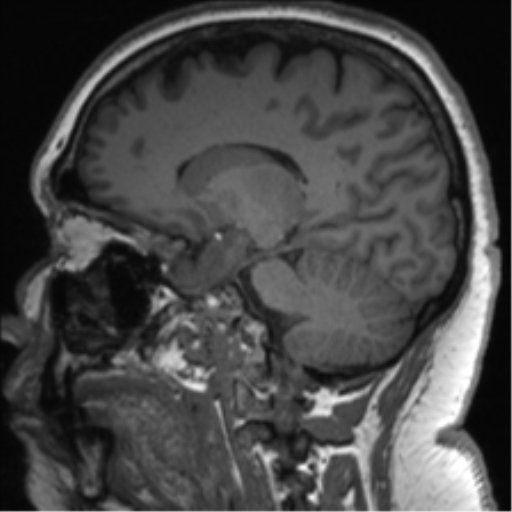 Cerebellopontine angle meningioma (Radiopaedia 48434-53348 Sagittal T1 54).png