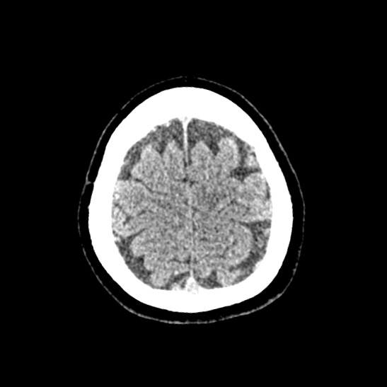 Cerebellopontine angle meningioma (Radiopaedia 53561-59592 Axial non-contrast 59).jpg