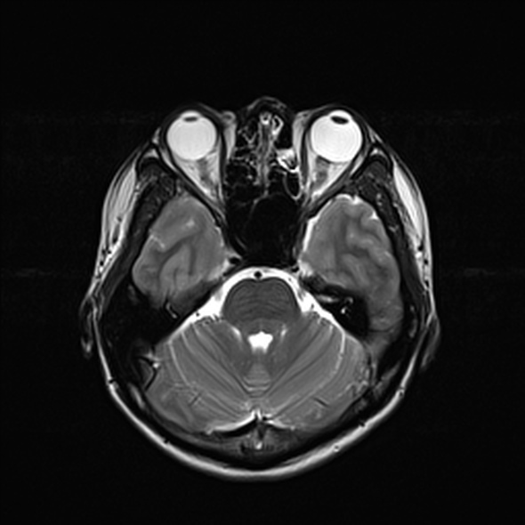 Cerebral abscess (Radiopaedia 24212-24478 Axial T2 22).jpg