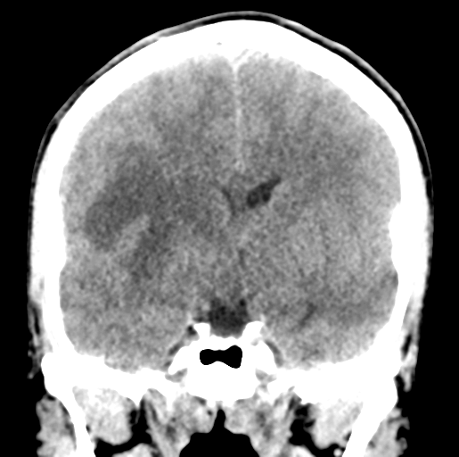 Cerebral abscess (Radiopaedia 60342-68008 Coronal non-contrast 30).png
