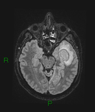 Cerebral abscess and subdural empyema (Radiopaedia 84436-99779 Axial FLAIR 52).jpg