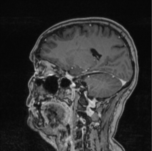 Cerebral abscess from pulmonary arteriovenous malformation (Radiopaedia 86275-102291 Sagittal T1 C+ 31).png